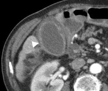 Cholecystitis at CT. The gallbladder is enlarged with edematous thickening of its wall (arrowhead), and some regional fat-stranding can be found.