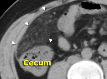 Same patient as above. Unenhanced CT depicts an area of fatty tissue with slightly increased density (arrowheads), in the right-upper quadrant. Compare this to normal low-density subcutaneous fat. Diagnosis: omental infarction.