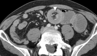 Obstructive ileus. CT depicts distended small bowel loops, but part of the small bowel and the whole colon is nondistended. Therefore this must be an obstructive small bowel ileus, and in this case its cause can easily be identified: intussusception (arrowhead).
