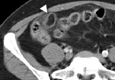 CT characteristic of epiploic appendagitis with a right-sided fatty mass surrounded by a hyperattenuating ring.