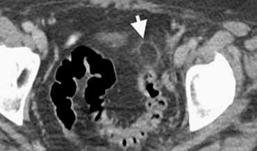 Left sided epiploic appendagitis in patient clinically suspected of having a diverticulitis.Characteristic hyperattenuating ring sign.