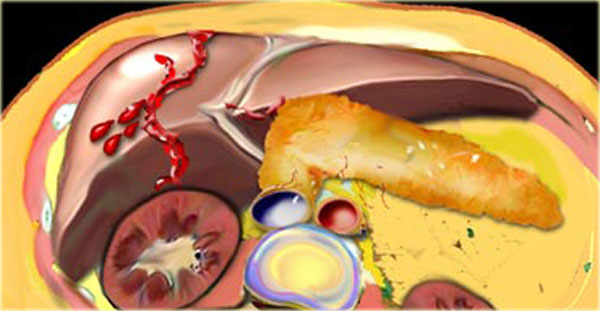 Liver laceration with active bleeding