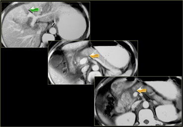 Right sided package injury involving the pancreas.