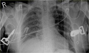 Chest film in a patient with right-sided injury.