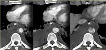 Consecutive images of the aorta at the level of the diafragm