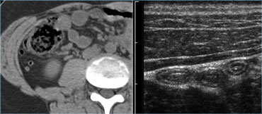 Visualization of the normal appendix by CT in an obese patient and by US in a lean patient.