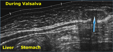 Realtime US allows to observe the effects of  Valsalva manoeuvre. Intra-abdominal fat is pressed into the abdominal wall (arrow) through an epigastric hernia.