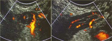 Acutely inflamed appendix in deep pelvic position. The appendix could only be visualized with the help of a transvaginal probe.