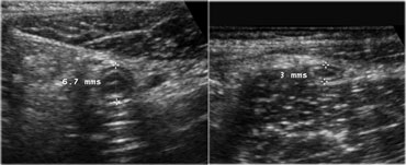 Transverse image of the normal appendix without (left) and with compression (right)