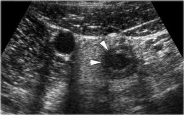 Acute appendicitis. The inflamed appendix shows local disturbance of the layerstructure indicating local transmural progression of the infection. The surrounding inflamed fat will probably effectively wall-off the imminent perforation.