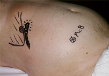 Inflamed appendix in unusual high position in a patient with clinical signs of cholecystitis. Due to its abnormal position far from McBurney's point (McB), the appendix was drawn on the skin with a waterproof pencil. This influenced site, size and orientation of the incision and facilitated the appendectomy.