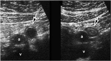 Spontaneous resolving appendicitis. LEFT: inflamed appendix with a dilated lumen and a diameter of 11mm. Patient experienced rapidly subsiding symptoms and did not undergo operation.RIGHT: Two days later the patient was symptom free. The appendix has decreased in size.