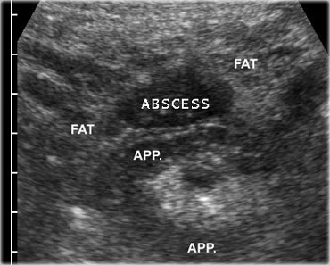 Acute appendicitis with a small periappendiceal abscess.