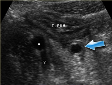 Pitfall. Secondary thickening of the ileum by appendicitis. If the prominent ileum is appreciated, but the inflamed appendix (arrow) is overlooked, an erroneus diagnosis of Crohn's disease or infectious ileocolitis can be made.