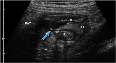 Crohn's ileitis with fistula (arrow) to the adjacent appendix. Note the focal loss of layer structure of the ileal wall and large masses of surrounding inflamed fat (fat).