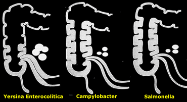 Infectious ileocecitis caused by Yersinia, Campylobacter, and Salmonella.