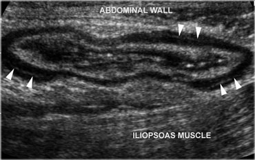 Normal, empty sigmoid. Axial view during relaxation and compression with the transducer shows the colonic anatomy the best. Note the three teniae coli, visible as a focal thickening of the muscularis layer. Note the separation of each tenia from the circular muscular layer by a thin, echogenic layer of connective tissue (arrowheads).