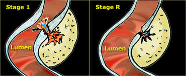 LEFT: Evacuation of pus and residual fecal material through the weakened sigmoid wall into the colonic lumen. RIGHT: Residual abnormalities remain fairly long after resolution of the symptoms.