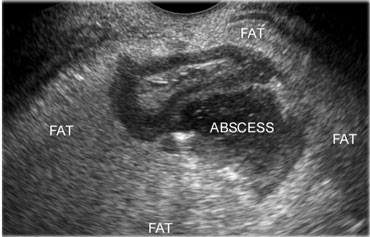 Paracolic abscess due to diverticulitis (transvaginal US)