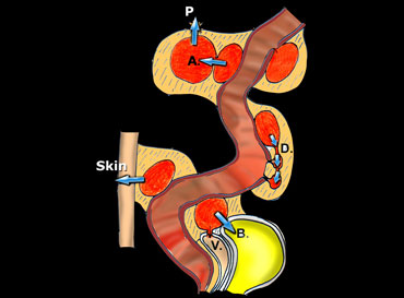 Schematic presentation of the natural evolution of sigmoid diverticulitis, once a paracolic abscess has developed.