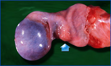 Testicular torsion with twisted spermatic cord (arrow).