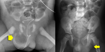 LEFT: herniated bowel in preterm.RIGHT: left-sided hernia in constipated child due to intermitted herniation of sigmoid.