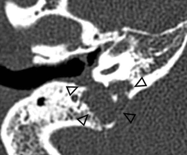 Langerhans cell histiocytosis arising from the jugular foramen