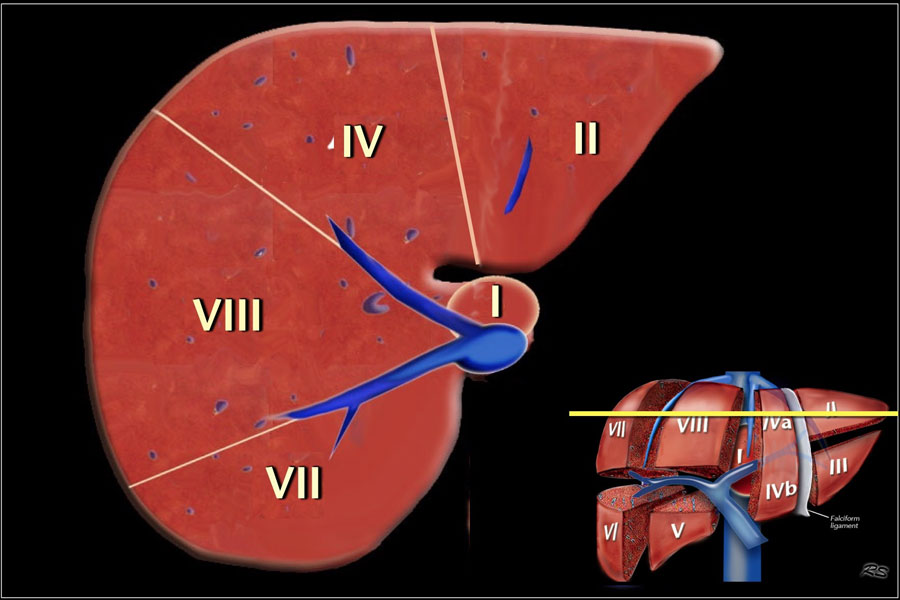 The Radiology Assistant : Liver - Segmental anatomy