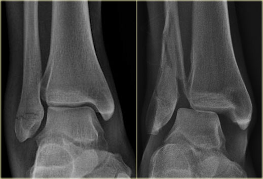 The Radiology Assistant : Ankle - Fracture mechanism and Radiography