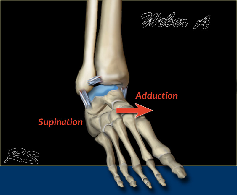 Ankle supination trauma