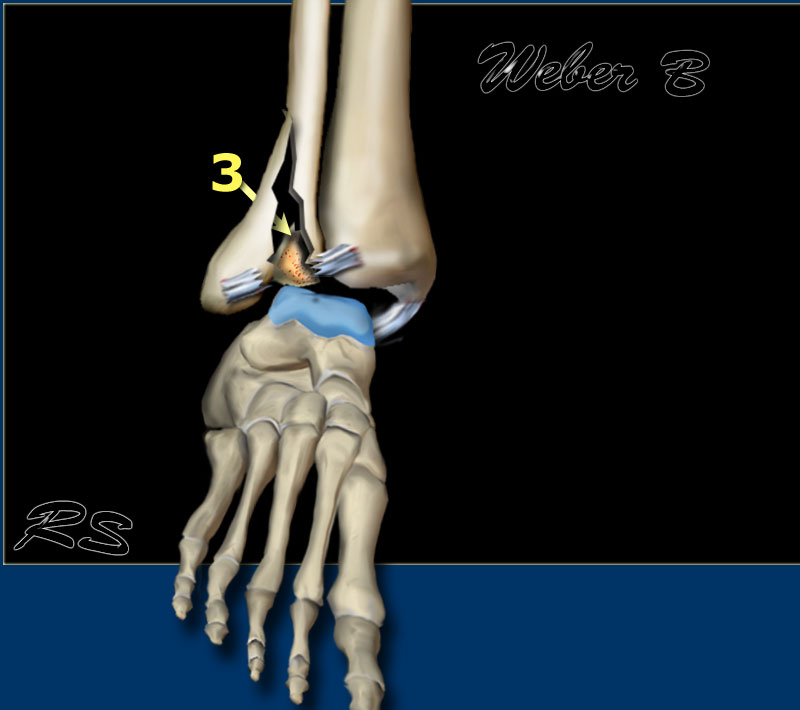 weber a lateral malleolus fracture