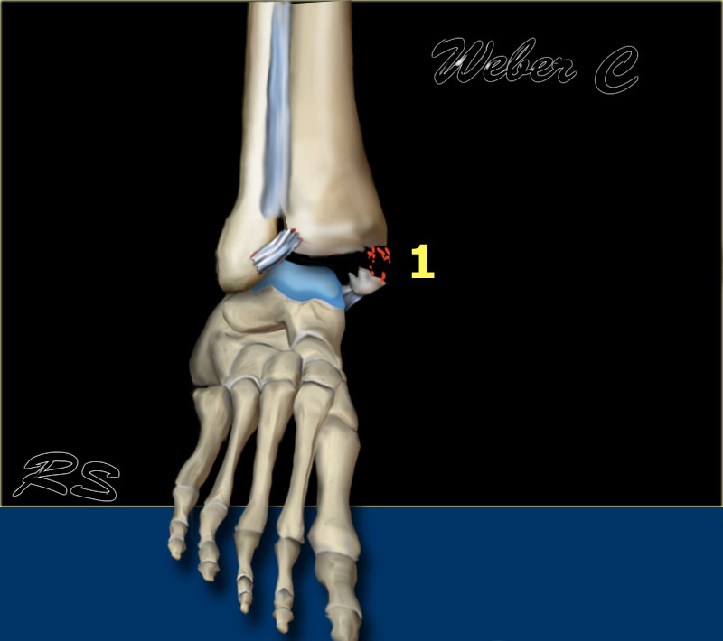 The Radiology Assistant : Ankle fracture - Weber and Lauge-Hansen ...