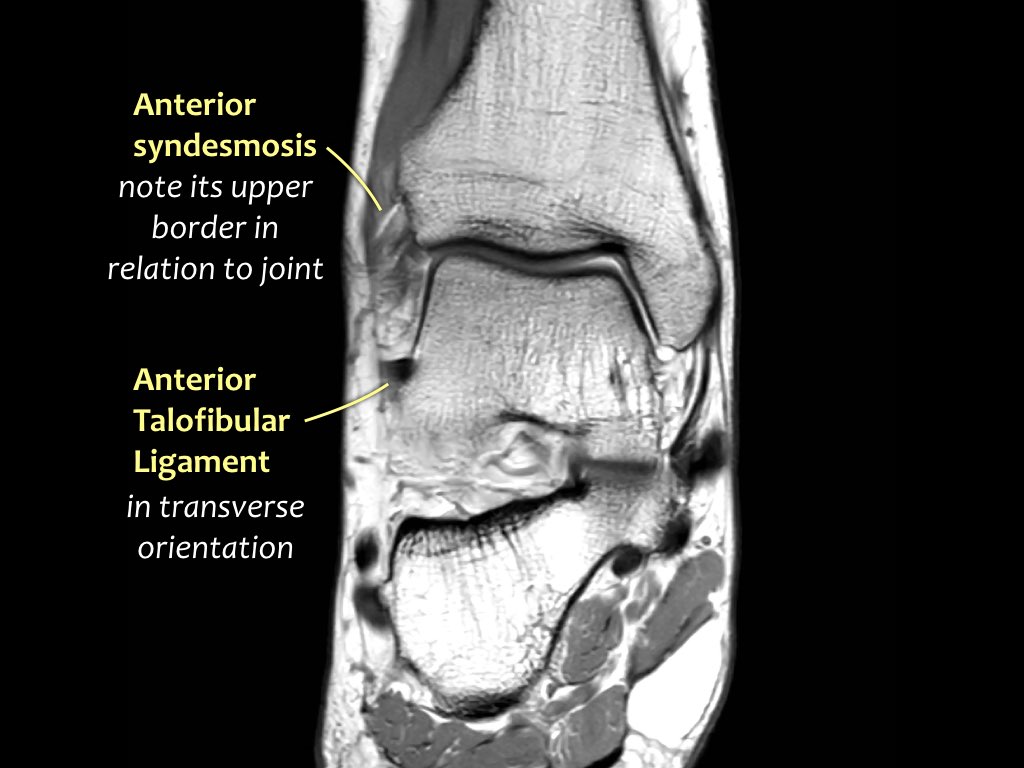 Mri Ankle Anatomy Ligaments 5309