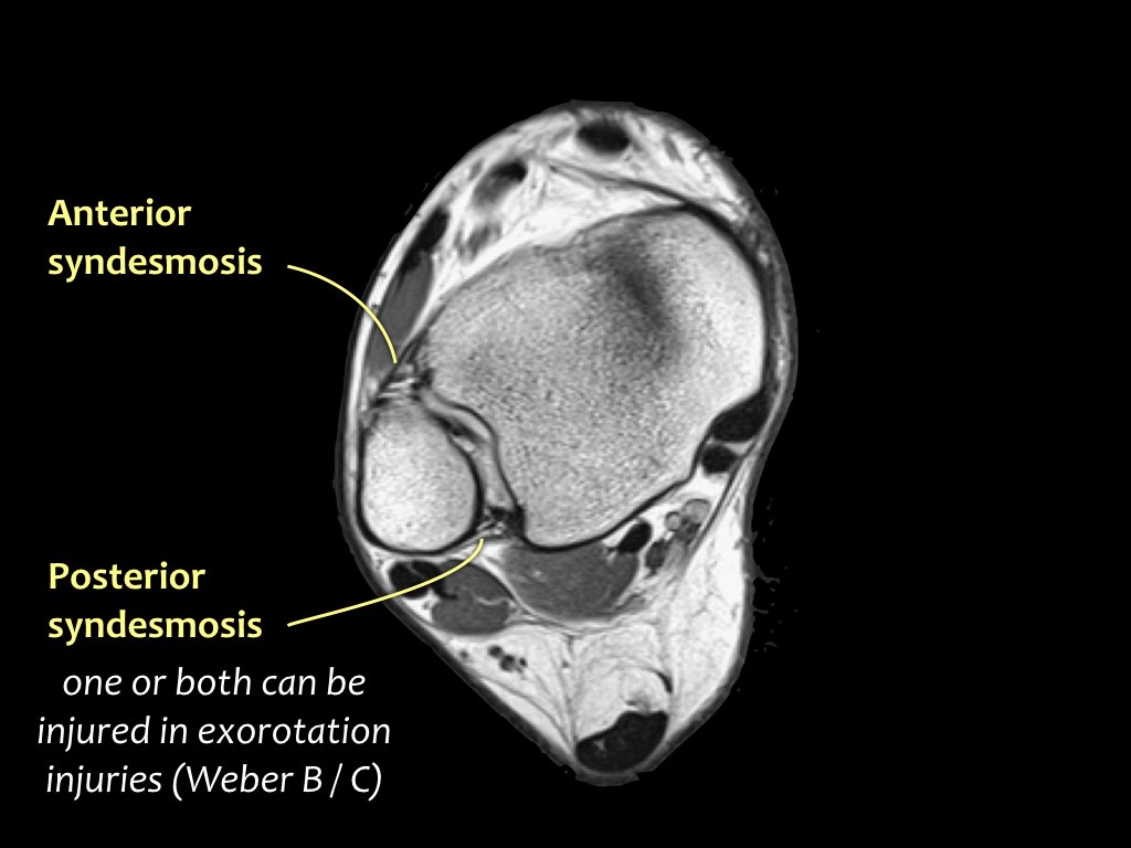 The Radiology Assistant : Ankle - MRI examination