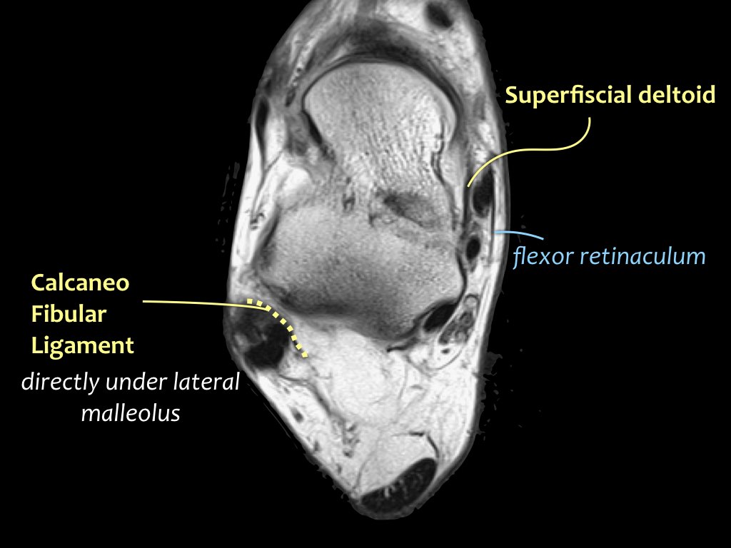 The Radiology Assistant : Ankle - MRI examination