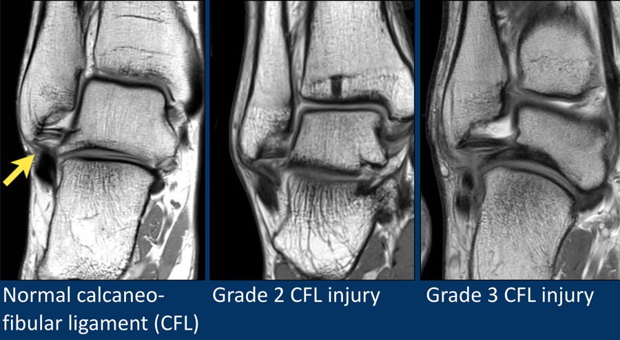 The Radiology Assistant Ankle Mri Examination 8050