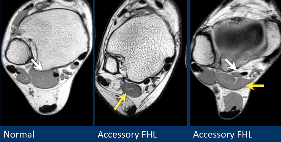 The Radiology Assistant : Ankle - MRI examination