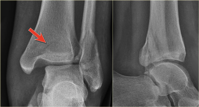 The Radiology Assistant Ankle Special Fracture Cases