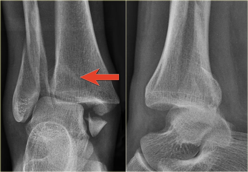 icd 10 code for distal fibula fracture