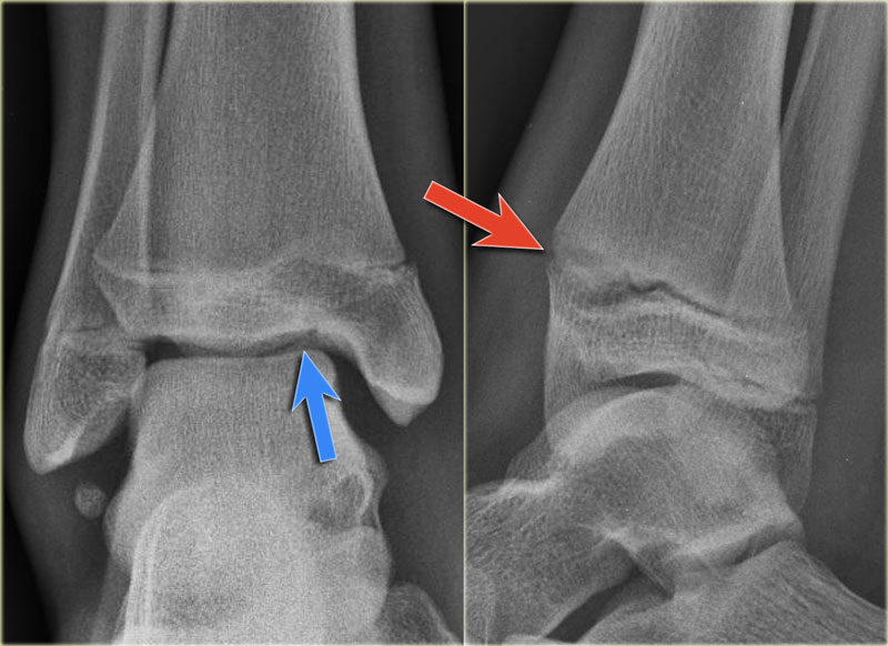 The Radiology Assistant Ankle Special fracture cases