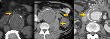 LEFT: Subtle periaortic stranding, MIDDLE: Hemorrhage into posterior pararenal and perirenal compartment, RIGHT: Extravasation of iv. contrast