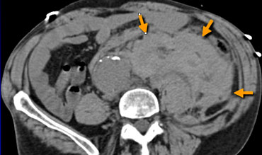 The Radiology Assistant : Aorta - Aneurysm rupture