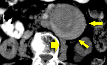 High-attenuating crescent sign in a patient with subtle evidence of leak adjacent to the right psoas muscle (broad arrow).