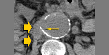 Tangential calcium sign (small arrow) and hemorrhage (broad arrow)