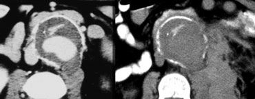 LEFT: draped aorta sign.RIGHT: two weeks later there is a rupture