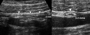 Fig. 1.- 34-year-old healthy volunteer with a normal appendix. A and B, longitudinal (A) and transverse (B) sonogram, showing the appendix (arrowheads) with a diameter less than the 7 mm cut-off point, surrounded by normal noninflamed fat.