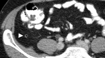 Fig. 2. A 50 year old man with a normal appendix. Unenhanced CT shows an air-filled nondistended appendix (arrowhead) with homogeneous periappendiceal fat without fat-stranding.