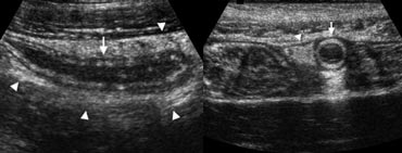 Fig. 3. A 19 year old woman with appendicitis.  Longitudinal  and transverse sonogram show an enlarged appendix (arrows) surrounded by hyperechoic inflamed fat  (arrowheads).