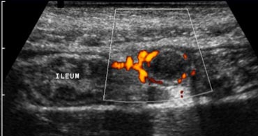 Fig. 3b. Power Doppler sonography shows hypervascularity of the appendiceal wall.