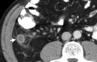 Fig. 4.- 43-year-old man with appendicitis. Contrast-enhanced CT depicts a fluid-filled distended appendix (arrow) with periappendiceal fat-stranding.